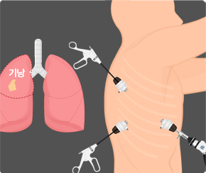 심혈관센터 흉강경폐수술