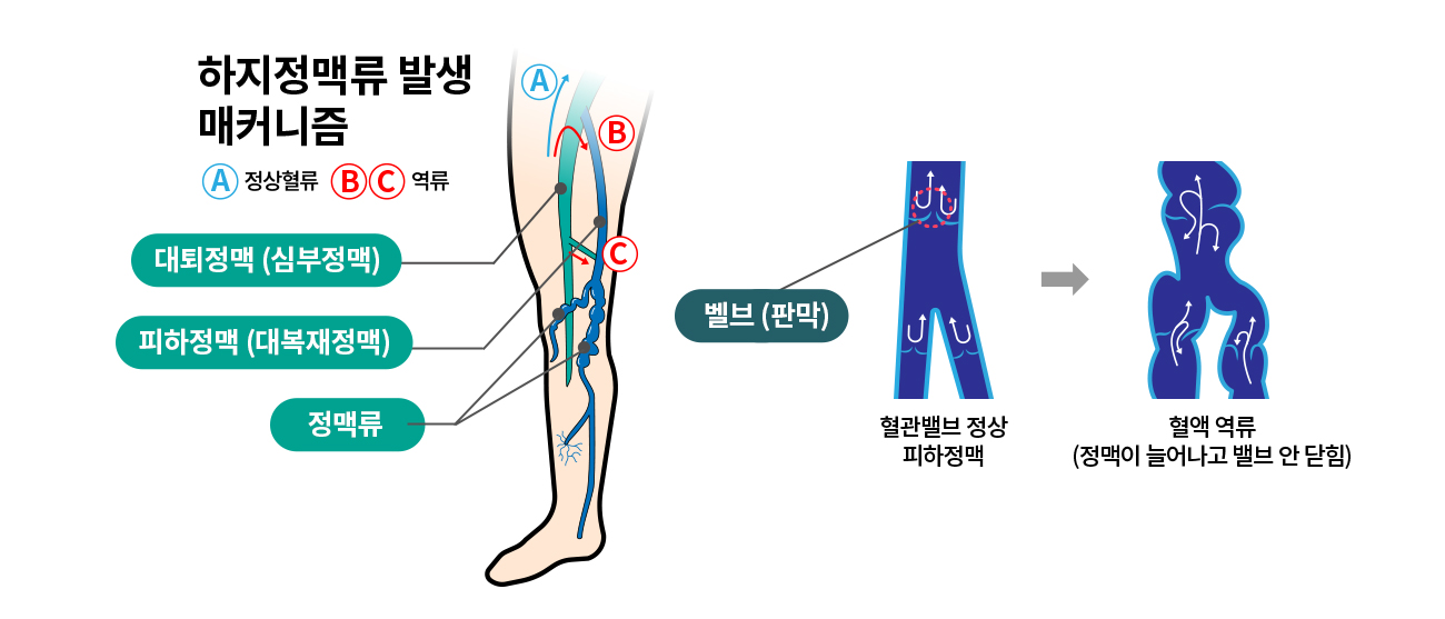 하지정맥류