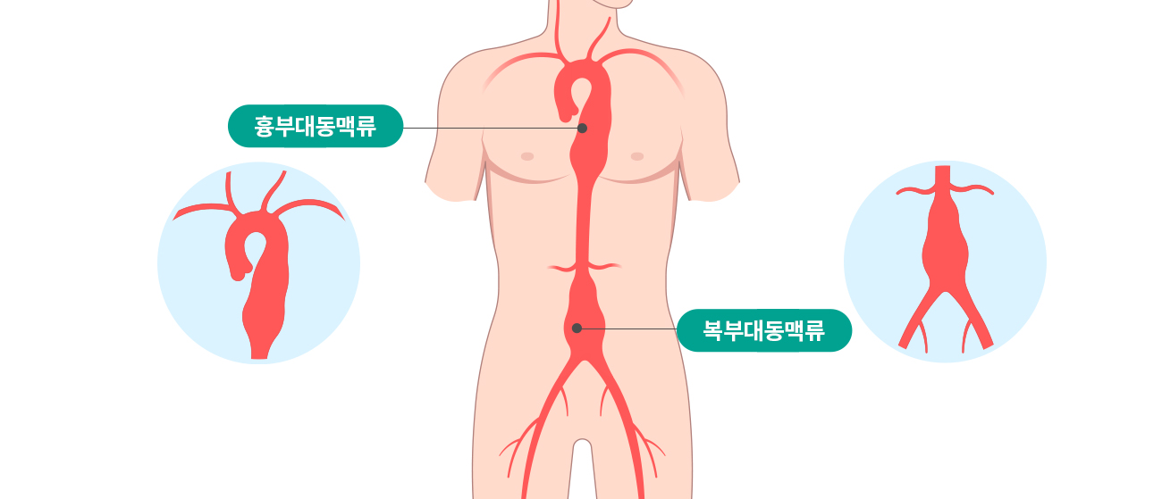 흉복부대동맥류