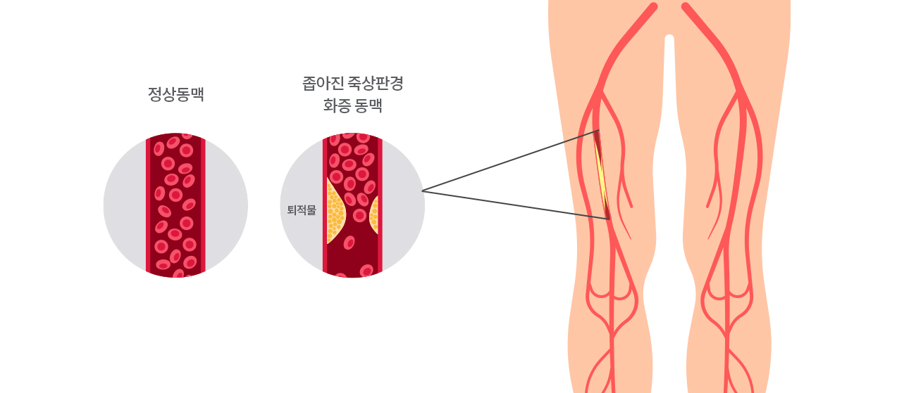 말초동맥질환