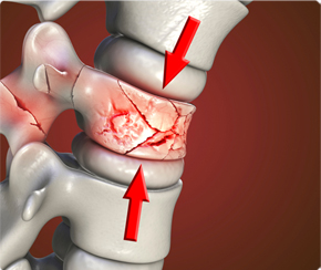 척추압박골절