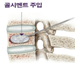 척추체 골시멘트 강화술/ 풍선 성형술