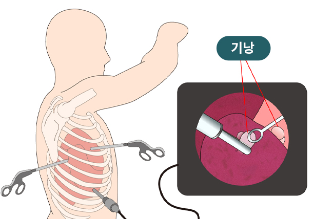 흉강경폐수술