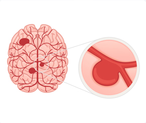 뇌혈관센터 뇌동맥류