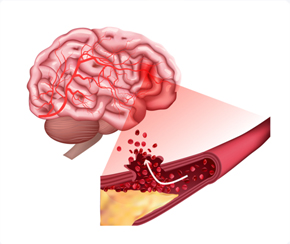 뇌혈관센터 뇌출혈