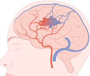뇌혈관센터 뇌경막동정맥루