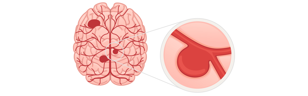 뇌혈관센터 뇌동맥류