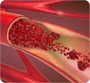동맥 벽의 약화