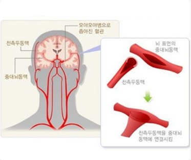 rTMS 및 재활치료