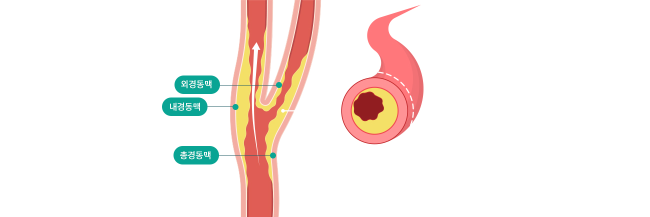 뇌혈관센터 경동맥협착