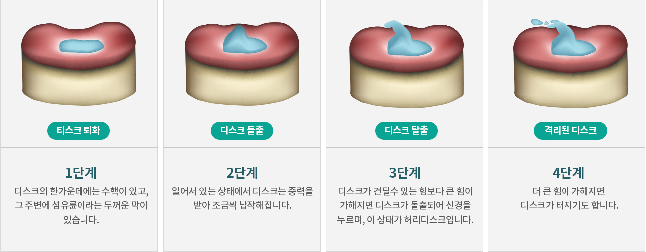 허리디스크