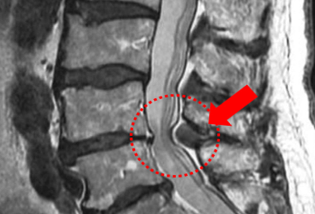 척추관 협착증