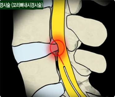 신경성형술