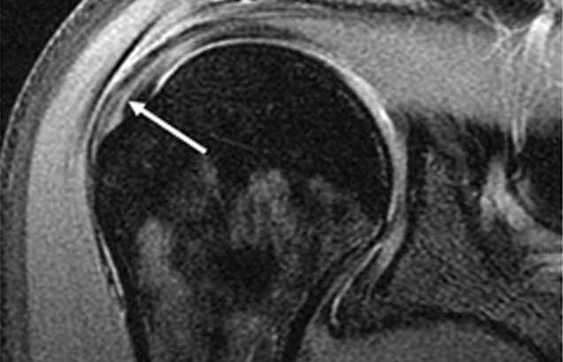 정상 어깨 MRI