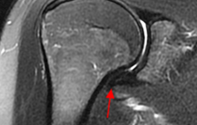 유착이 발생된 관절낭 MRI