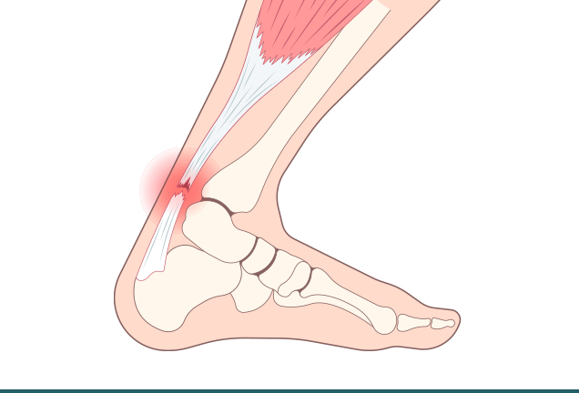 아킬레스파열