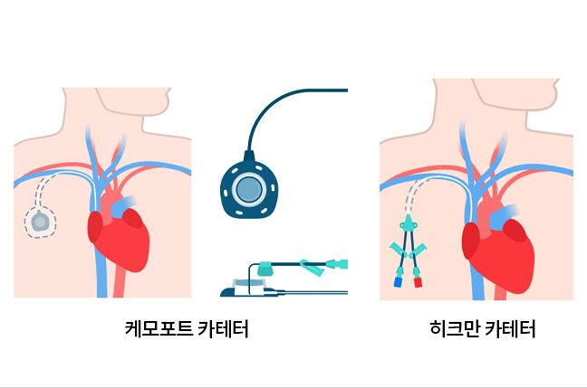 케모포트&히크만 카테터