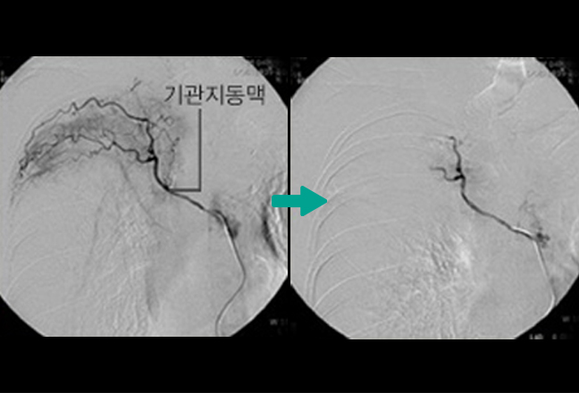 혈관조영술 및 혈관 성형술, 색전술, 혈전 제거술