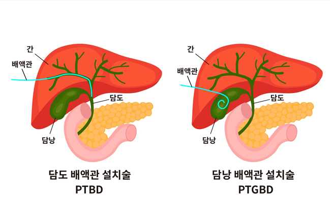 담도, 담낭 배액관 설치술