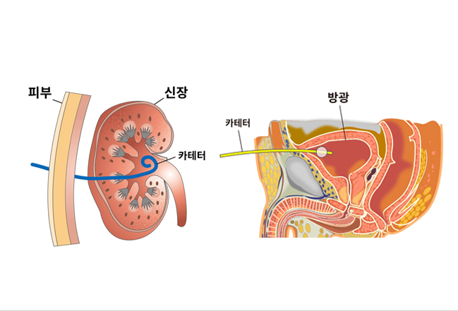 신루 설치술, 방광루 설치술