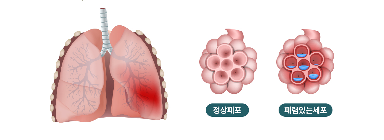 폐렴