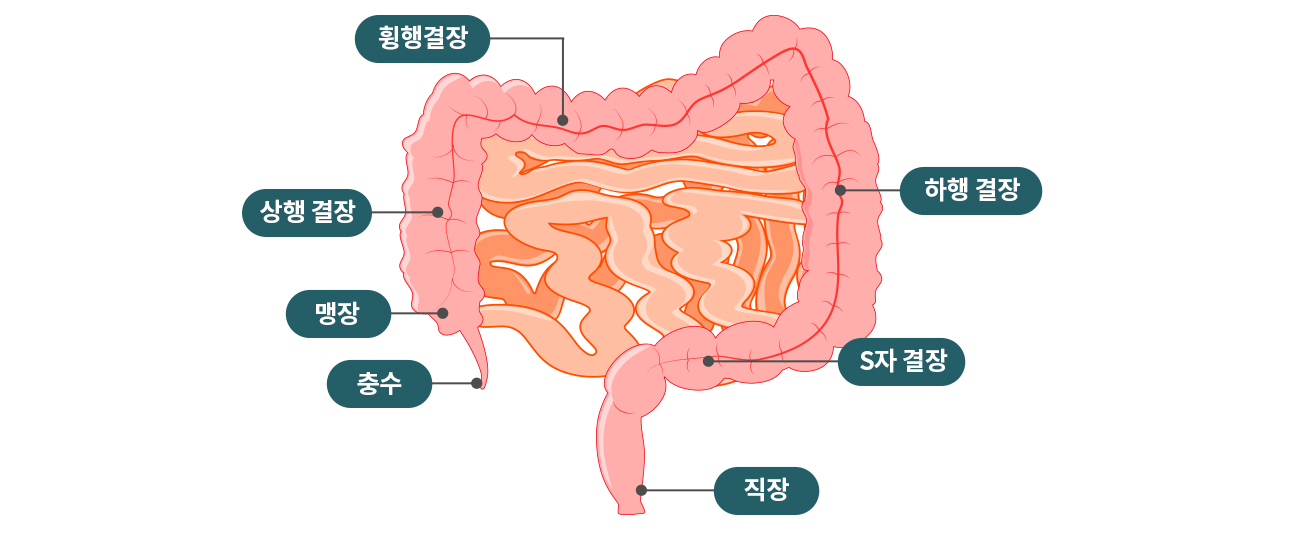 대장질환