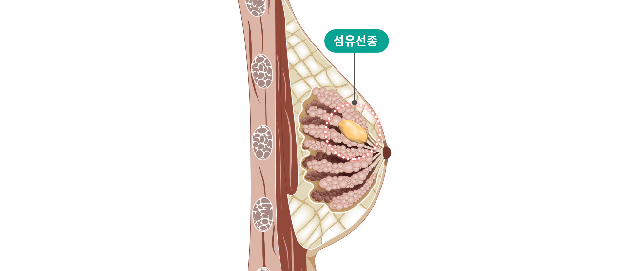 유방양성질환