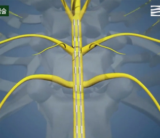 척수신경자극술