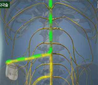 척수신경자극술